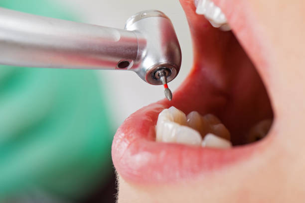 Best Emergency Tooth Extraction in Woodsi East, DE